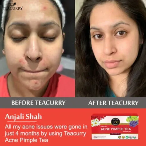 Acne Tea - Helps in Pimples, Cysts, Pustules & Nodules
